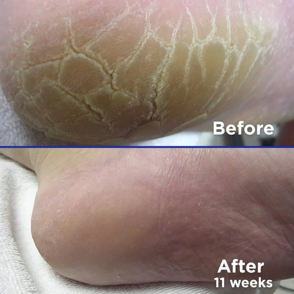 cracked heels